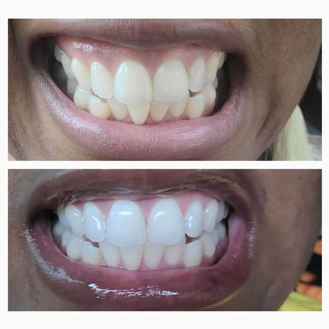 Snow Sensitive Whitening Toothpaste Before & After